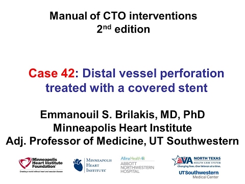 Case 42: Manual of CTO Interventions: Distal vessel perforation treated with a covered stent