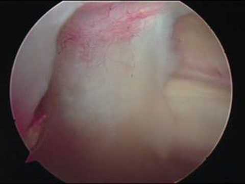 Construcion Of Glenohumeral Ligament