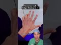 Hello, my name is… #inigomontoya #6 #Fingers #Hand #Polydactyly #Viral #FYP #princessbride