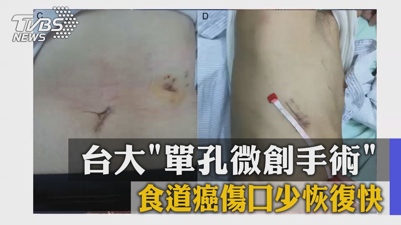 台大單孔微創手術 食道癌傷口少、恢復快