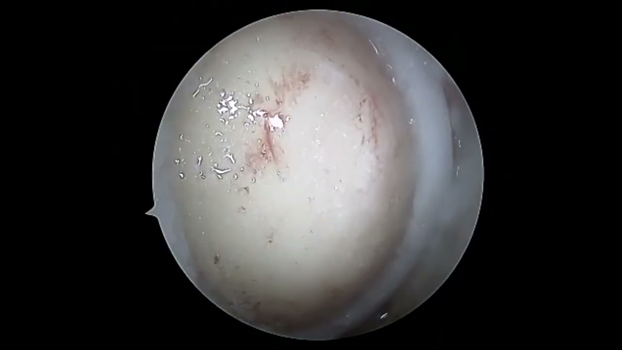 MFC Arthro MACI