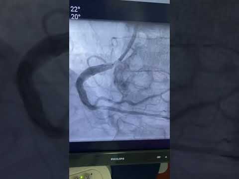 RCA ostial PCI