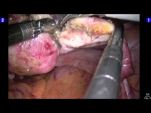 Robotic Hysterectomy (Laparoscopic)
