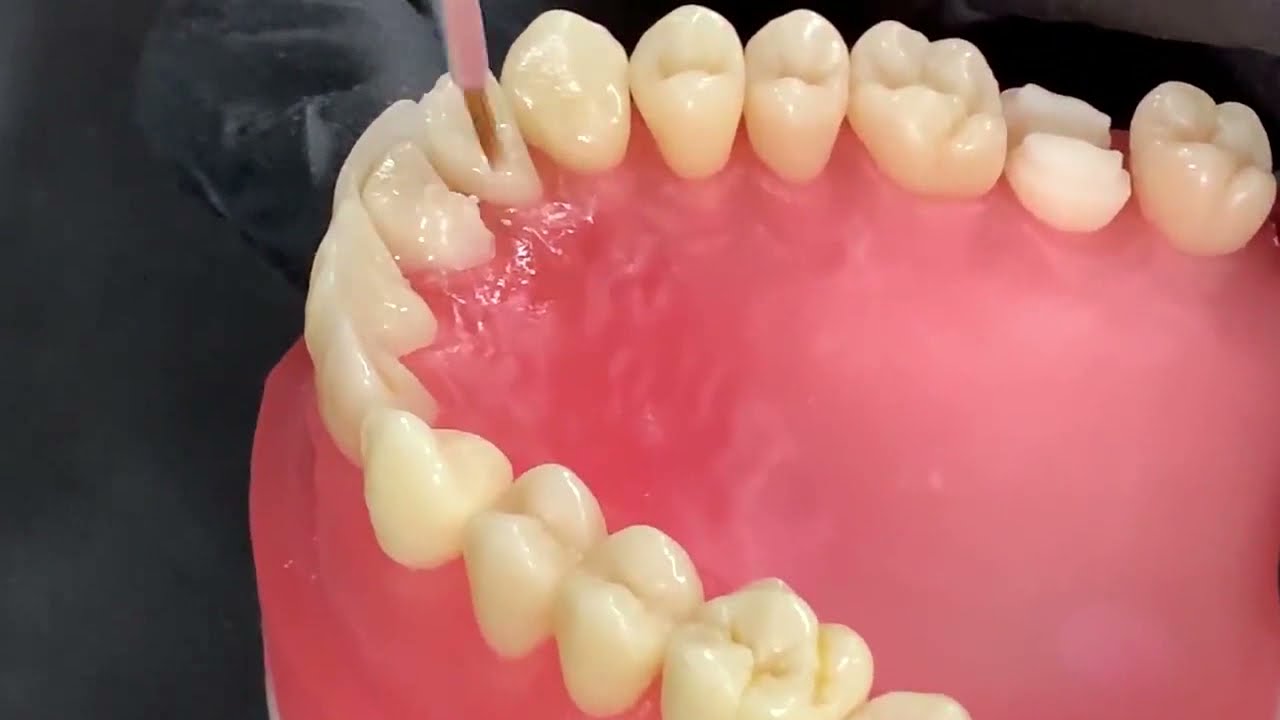 Restauração provisória indireta/ coroa provisória - técnica do dente de estoque