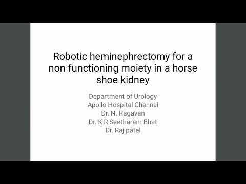 Robotic heminephrectomy for a non functioning moiety in a horse shoe kidney