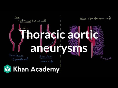Thoracic aortic aneurysms | Circulatory System and Disease | NCLEX-RN | Khan Academy