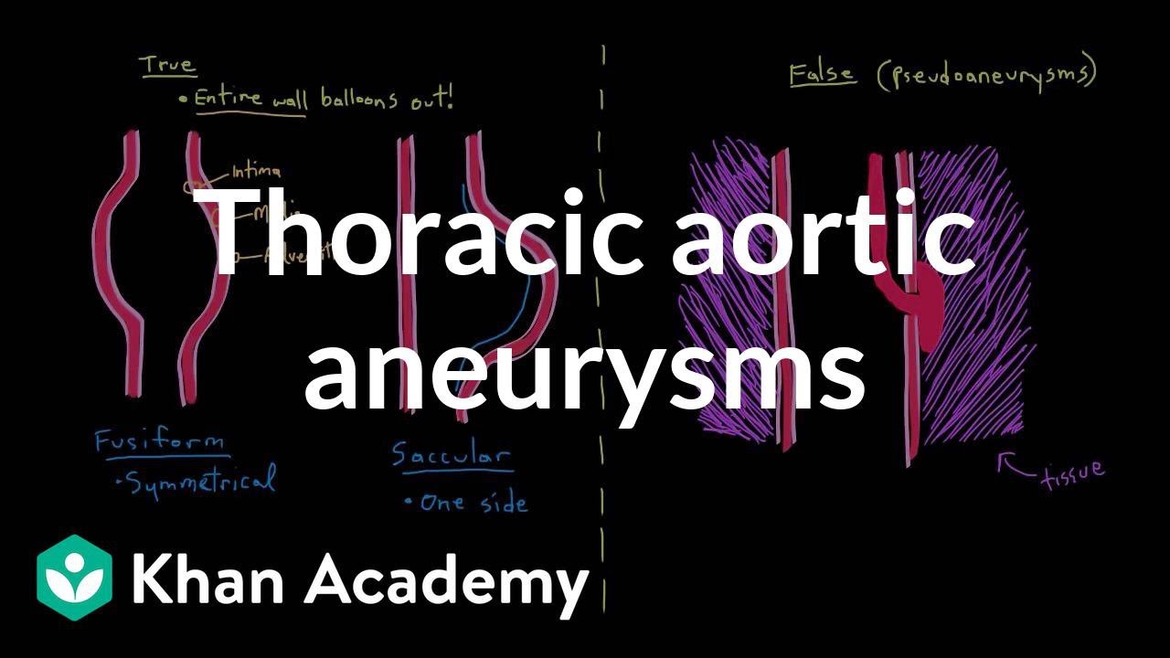 Thoracic aortic aneurysms | Circulatory System and Disease | NCLEX-RN | Khan Academy