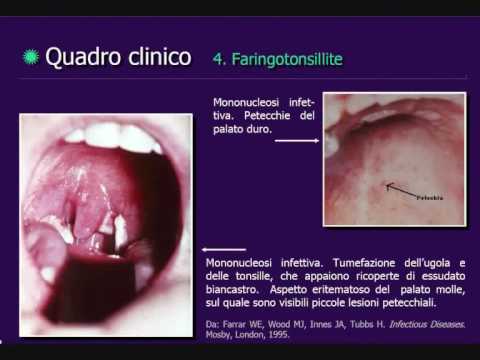 ANIBALDI.IT - Mononucleosi Infettiva