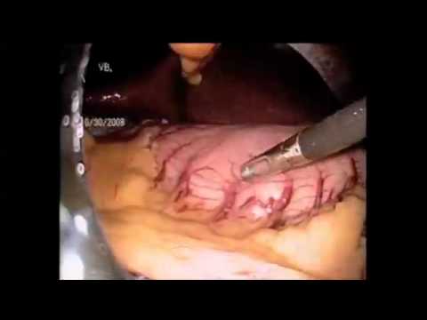 Bariatrische Chirurgie: Singe-Port-Technik
