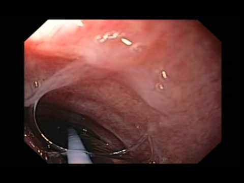 Intubation par inadvertance des voies respiratoires autour d'un tube endotrachéal