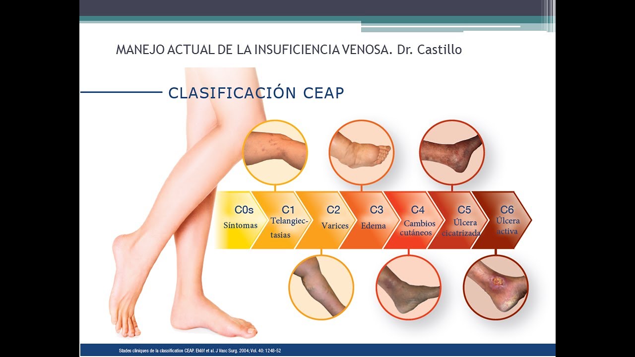 Tratamiento de las Várices - Insuficiencia Venosa