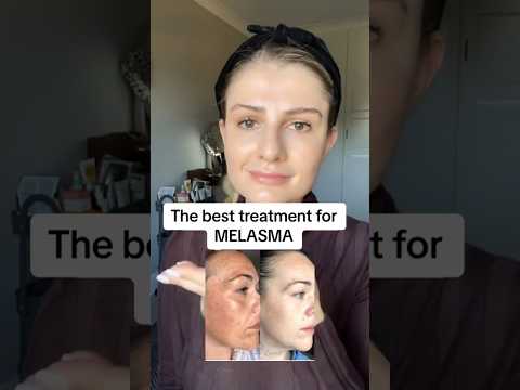 The best treatment for melasma! #skincare #skinadvice #skincaretips #hyperpigmentationtreatment