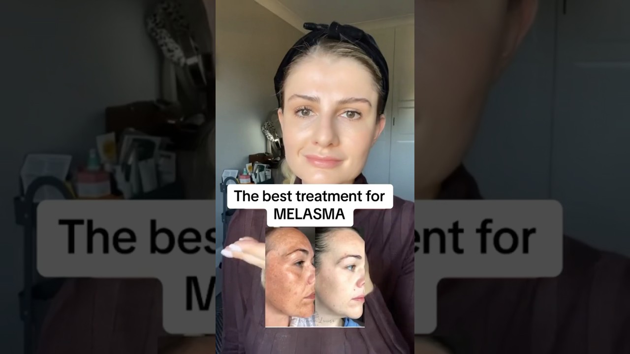 The best treatment for melasma! #skincare #skinadvice #skincaretips #hyperpigmentationtreatment