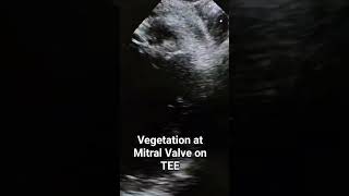 Download lagu Infective Endocarditis: Mitral Valve Vegetation Explained | Trans Esophageal Echocardiography mp3 Download lagu Infective Endocarditis: Mitral Valve Vegetation Explained | Trans Esophageal Echocardiography mp3
