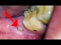 Wisdom Tooth Pain: What you NEED to Know (Oral Sedation, Home Remedies and What to Expect)
