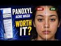 PanOxyl Acne Wash Review Did It Really Clear Acne