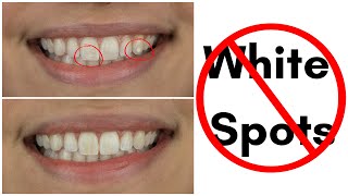 !NEW PROCEDURE🦷! How to Reverse White Spots Lesions on Teeth
