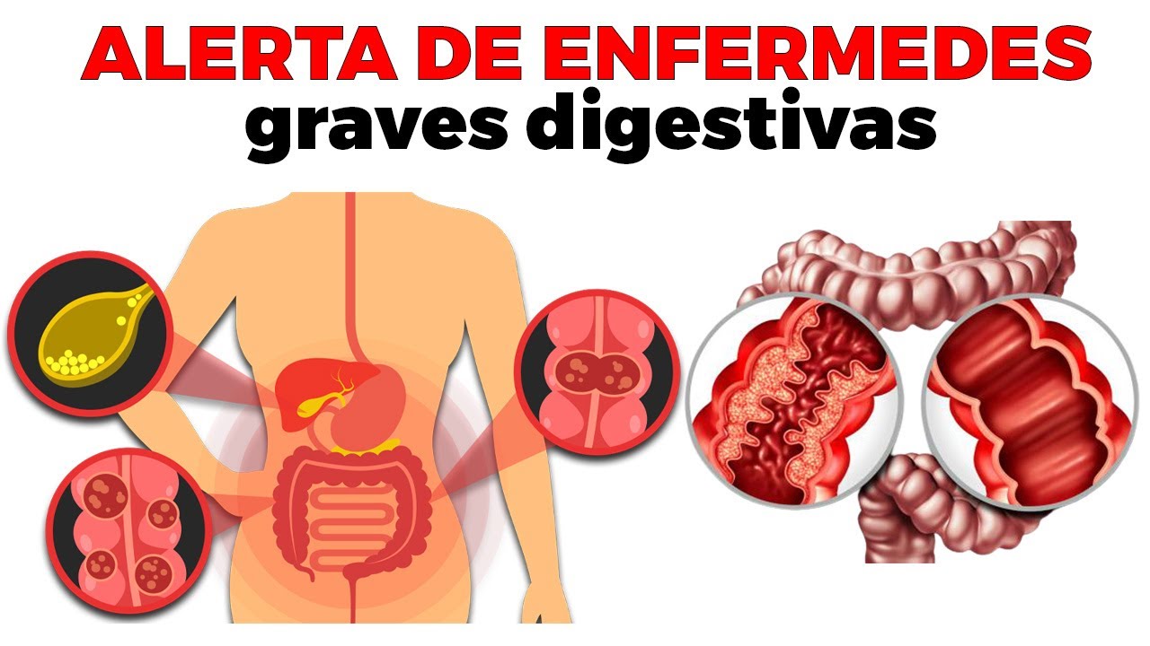 ¿Cuáles son las 5 enfermedades del sistema digestivo? ES General