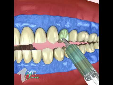 Laser Clinical Teeth Whitening (Philips Zoom) - Surgical Procedure - One Clinic Patient Review Video