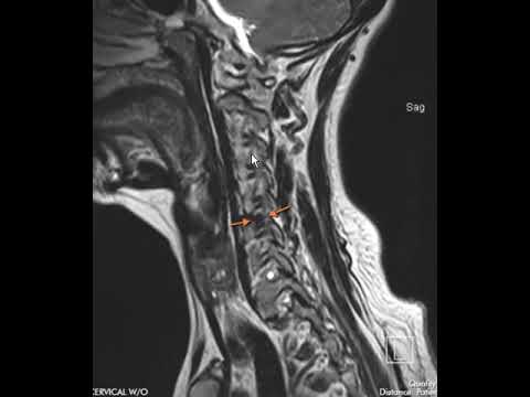 Typical disc herniation of cervical spine