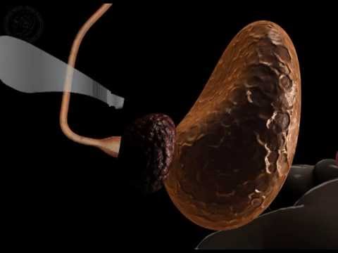 Verkalkung der Prostata oder fokalen Prostatitis und Auswirkungen der Krankheit