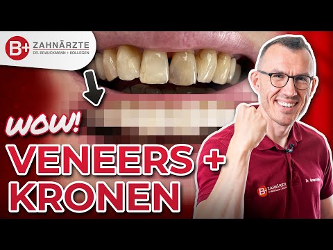 Endlich befreit lächeln können! Schöne Zähne dank Veneers und Zahnkronen - inkl. Vorher-Nachher!