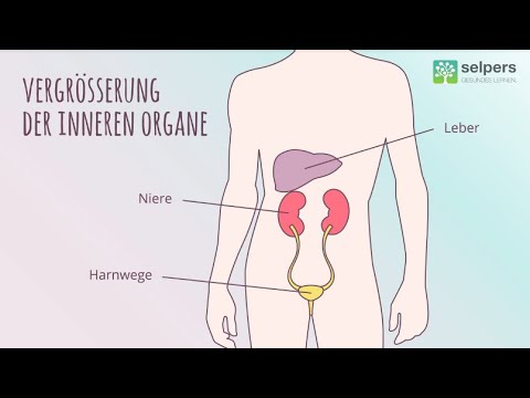Schlafapnoe durch Akromegalie – Wie verändert sich der Schlaf? (Experte erklärt)