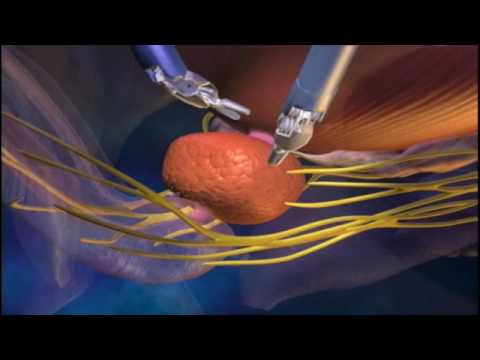 Quanto è il trattamento del cancro alla prostata Velcro prostatite