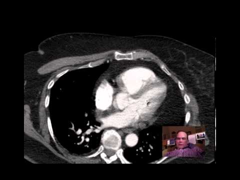CT Chest for SOB w PE (Pulmonary Embolism)  DISCUSSION by Radiologist
