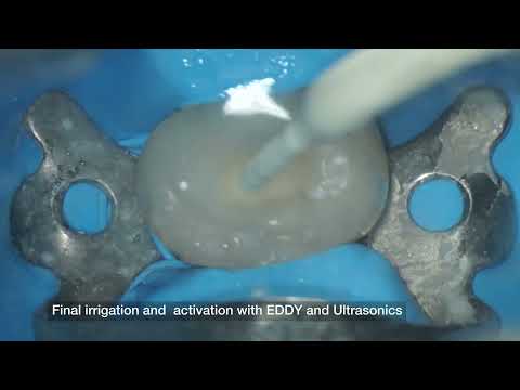 VDW Dental · Grande & Plotino  RECIPROC blue Vídeo clínico de preparación paso a paso