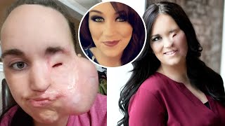 Mother Permanently Disfigured After Falling Face First Onto Curling Iron
