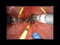 Single Port Robot Assisted Transvesical Repair Of A Vesicovaginal Fistula Graphic