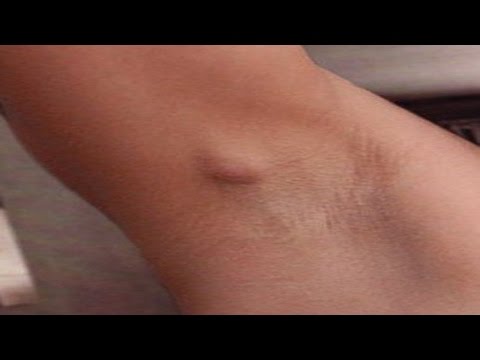 Analogue lamizila fungus toe nail Kaysa sa pagalingin basag kuko