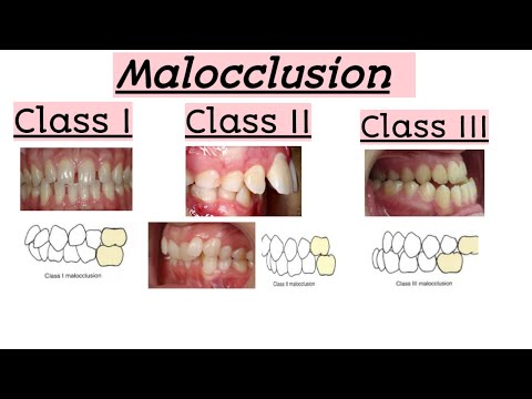 malocclusions..Class I,Class II,Class III..Clinical features..Quick Revision
