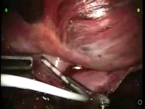 Atrial Fibrillation Treatment With Microwave Ablation - Robot Assist