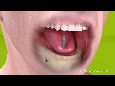 Wie hält eine Prothese auf Implantaten? Prothese auf Zahnimplantaten Köln.