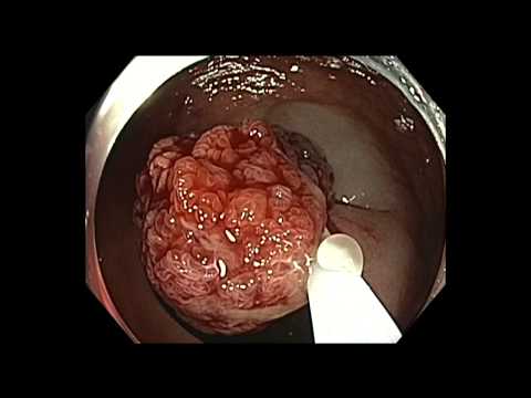 Colonoscopy: Rectum Polyp - Giant Polyp Resection