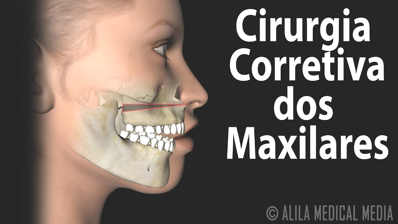 Cirurgia Corretiva dos Maxilares, Animação. Alila Medical Media Português