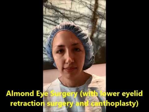 Almond Eye Surgery with Cantoplasty Almond Eye Surgery with Cantoplasty