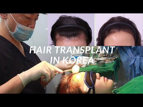Hair Transplantation in Korea | Seoul Guide Medical