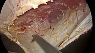Laparoscopic Rives Stoppa | TARM | Transabdominal Retrorectus Mesh Hernioplasty for Umbilical Hernia