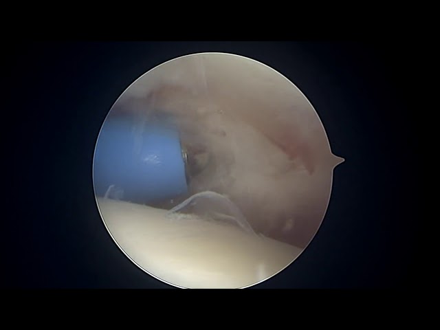MP scope for RCL articular fracture