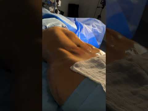 A tecnologia mais moderna em cirurgia plástica, Argo plasma, para tratar flacidez de mães