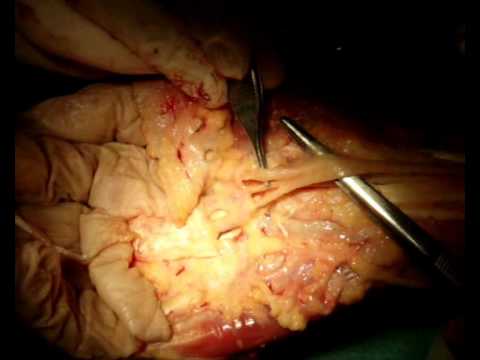 comment guerir syndrome canal carpien
