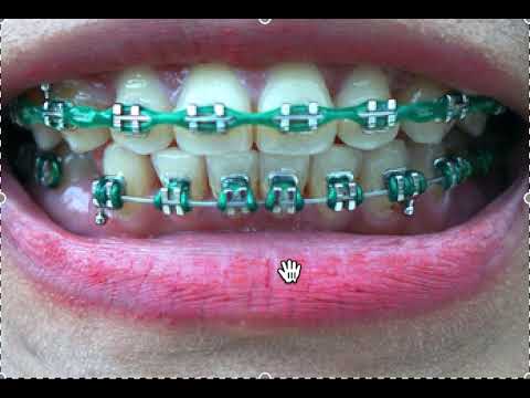 Braces Case Presentation- overjet/overbite/steel tie/ power chain