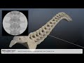 Minuteman Spinal Stenosis