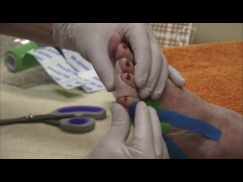 Podo-Taping-Concept© - Interdigital - Hühnerauge mit Orthose