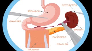 My Laparoscopic Splenectomy Surgery Experience (GRAPHIC)