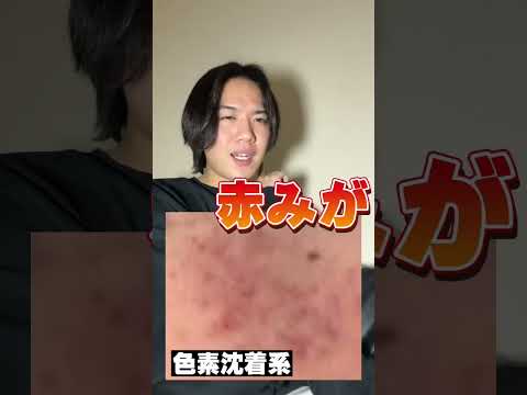 ニキビ跡を取り除く方法 – 軟膏と治療法