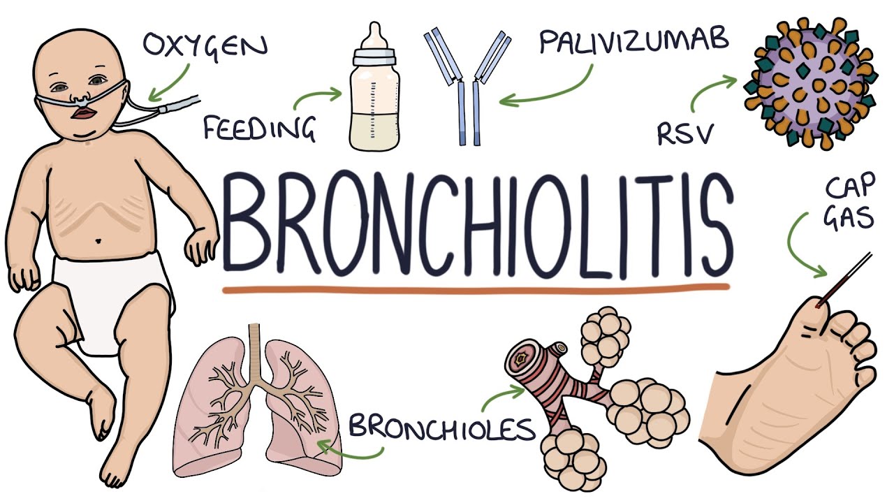 Understanding Bronchiolitis